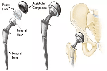 Hip dysplasia best sale surgery cost human